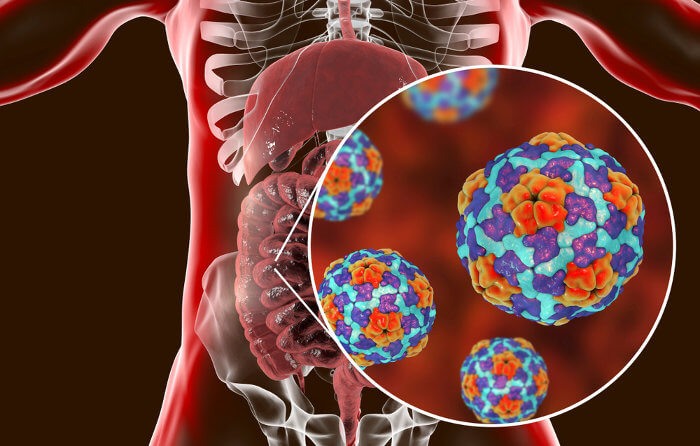 A hepatite A é causada por um vírus de RNA que afeta o fígado.