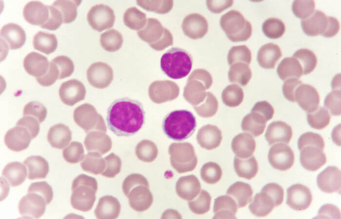 Observe na imagem a fotografia do sangue visto pelo microscópio. É possível observar a presença de três leucócitos no centro da foto.