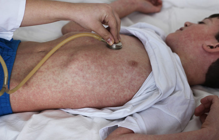 O sarampo é uma doença grave que se destaca pela presença de manchas vermelhas no corpo.