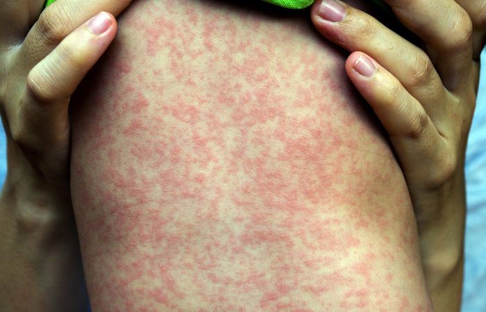 Um dos principais sintomas do sarampo é o surgimento de manchas pelo corpo.