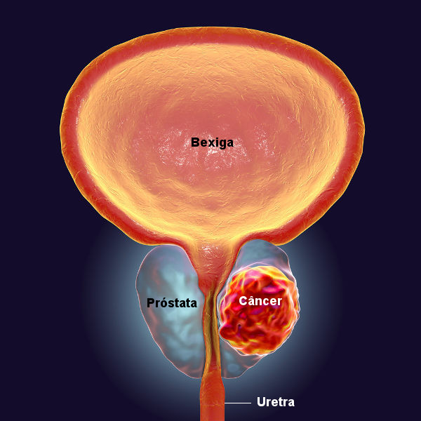 O câncer de próstata pode desencadear problemas como micção frequente e sangue na urina.