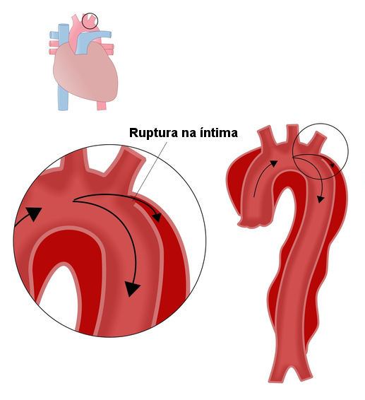 Observe no esquema a separação das camadas da parede da aorta.