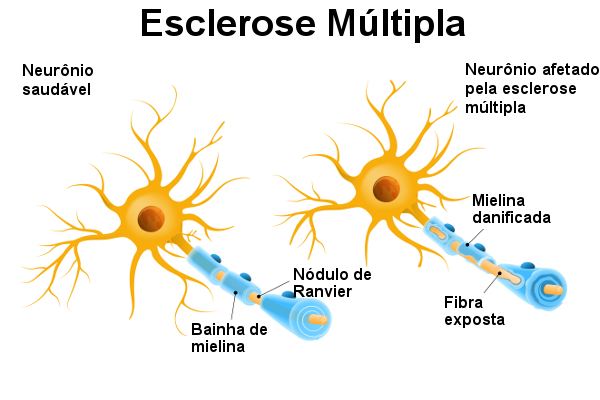 A esclerose múltipla provoca a desmielinização dos neurônios.