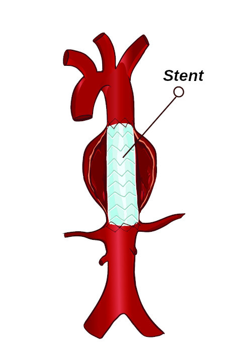 A figura ilustra a colocação de prótese endovascular no tratamento de um aneurisma da aorta abdominal.