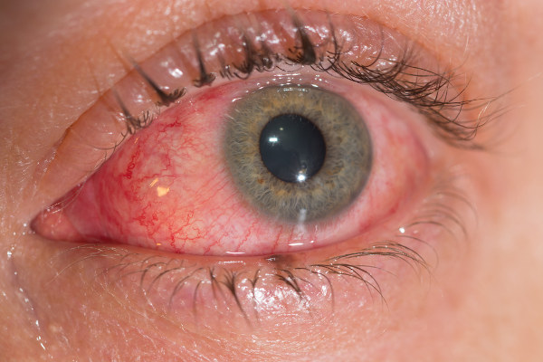 A conjuntivite é a inflamação da conjuntiva e pode provocar vermelhidão nos olhos.