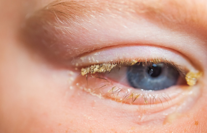 Além dos olhos vermelhos, a conjuntivite pode causar a produção de secreção amarelada ou esbranquiçada.