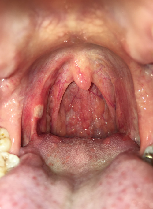 A faringite é uma inflamação da faringe, a qual provoca dor na região da garganta.
