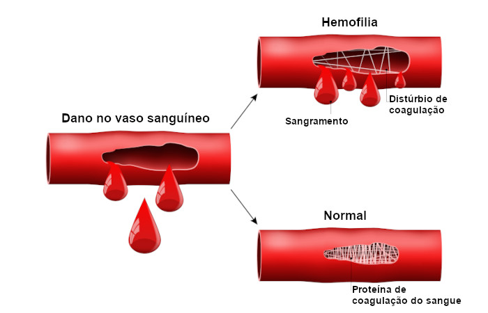 Na hemofilia, a coagulação é afetada devido a deficiências nos fatores de coagulação.
