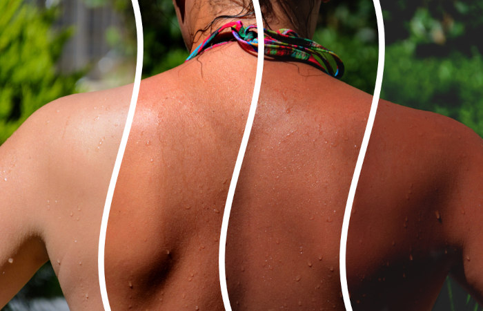 A cor da pele pode sofrer alteração devido à exposição ao Sol.