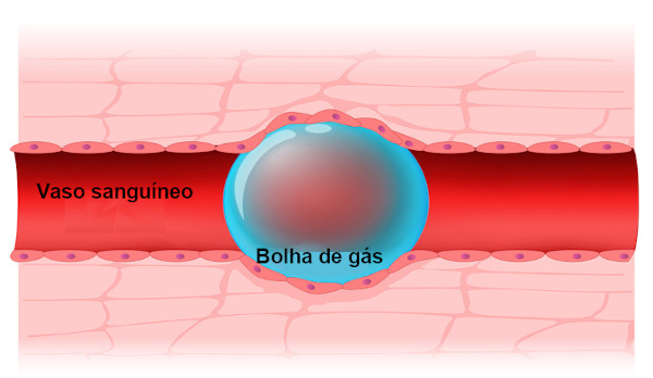 A embolia gasosa é caracterizada pela presença de bolhas de gás no interior de vasos sanguíneos.