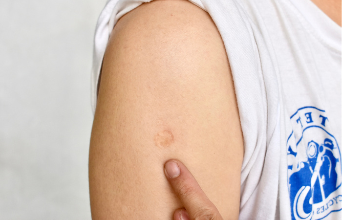 Foto de um braço marcado com a cicatriz da vacina BCG, indicada com um dedo.