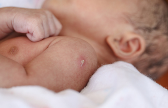 A vacina BCG deve ser aplicada, preferencialmente, logo após o nascimento.
