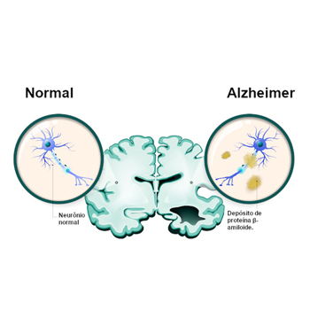 Alzheimer Alzheimer