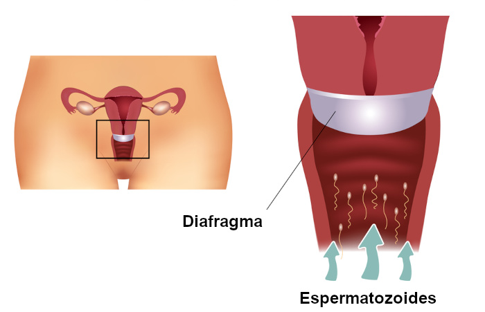 Ilustração de como o diafragma deve ser inserido, de modo a cobrir o colo uterino.