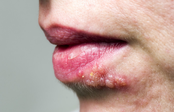 O herpes labial leva ao surgimento de lesões na região da boca. O beijo pode transmitir a doença.
