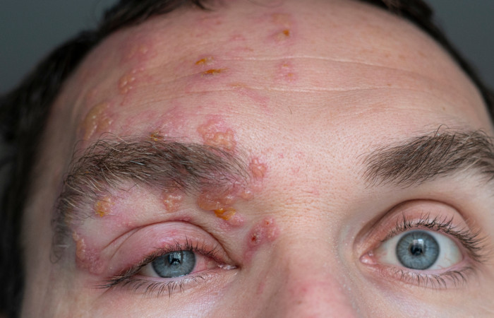 Manifestação de herpes-zóster em parte do rosto.