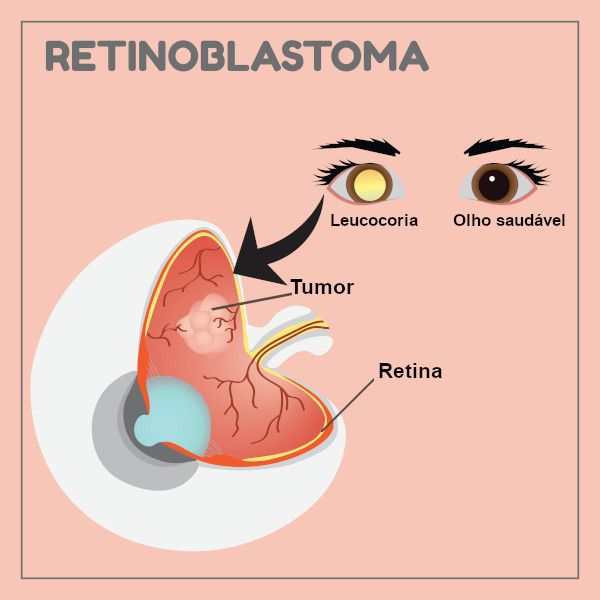 Ilustração esquemática da leucocoria em caso de retinoblastoma