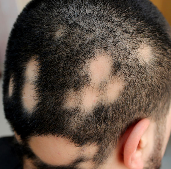 Homem com várias falhas circulares de cabelo na região da cabeça por ter alopecia areata.