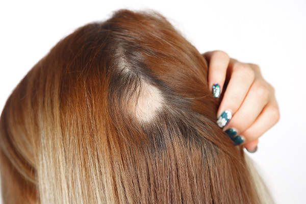 Moça com falha nos cabelos, decorrente de alopecia areata, tocando a cabeça.