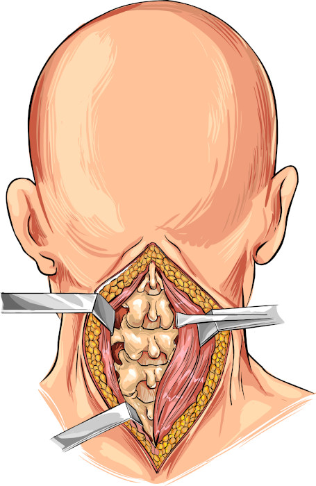Ilustração da dissecção da coluna cervical.