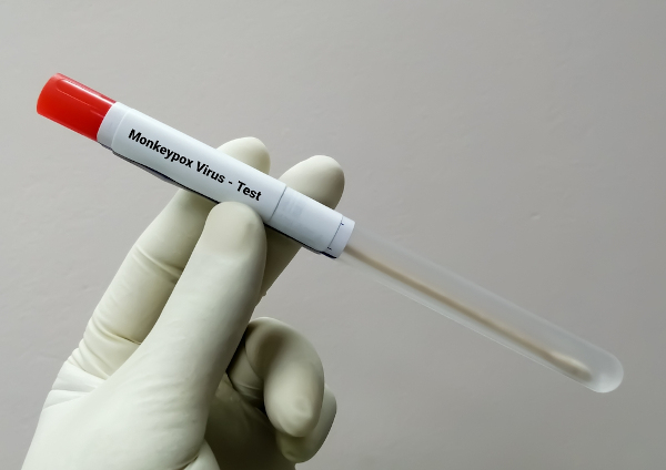 Pessoa com luva branca segurando um tubo com amostra de fluidos para teste de vírus da varíola dos macacos