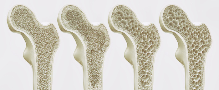 Representação da evolução da osteoporose nos ossos.