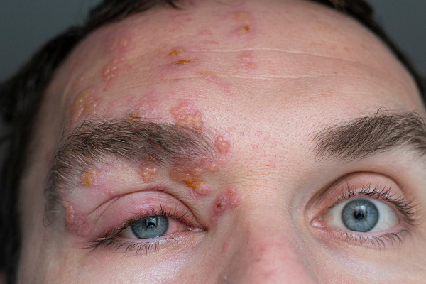 Homem com lesões provocadas pela herpes-zóster no olho e na lateral esquerda da testa.