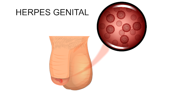 Ilustração de um pênis com lesões provocadas por herpes genital.