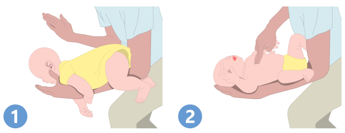  Ilustração indicando o que deve ser feito se um bebê estiver engasgando.