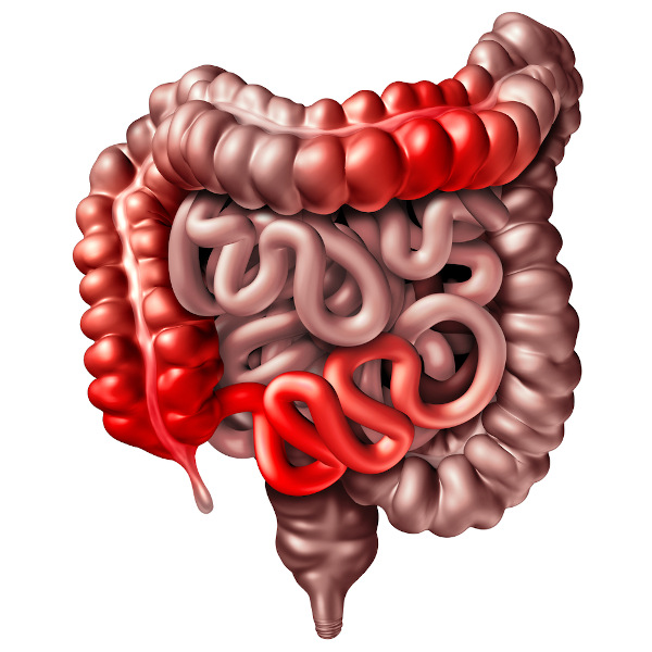 Representação do intestino humano com doença de Crohn.
