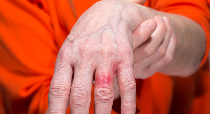 Dermatite alérgica desenvolvida na mão de uma pessoa devido à sensibilidade ao níquel.