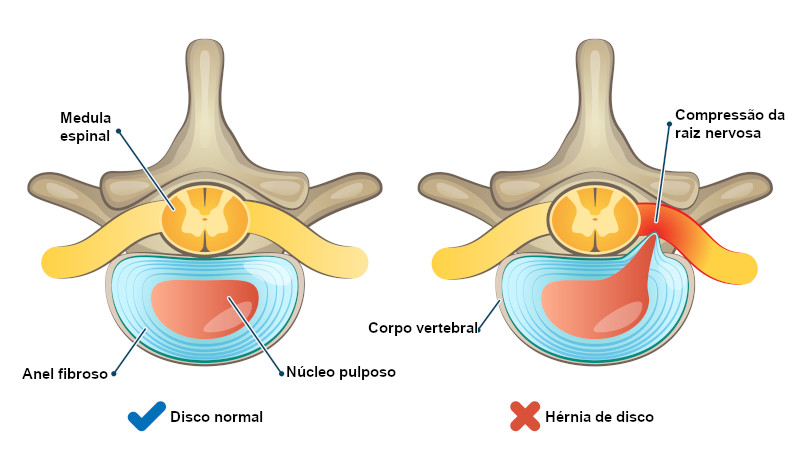 Hérnia de Disco: o que é, causas e revisão anatômica - Sanar Medicina