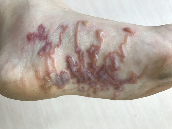 Lesões visíveis em um pé causadas por bicho-geográfico.