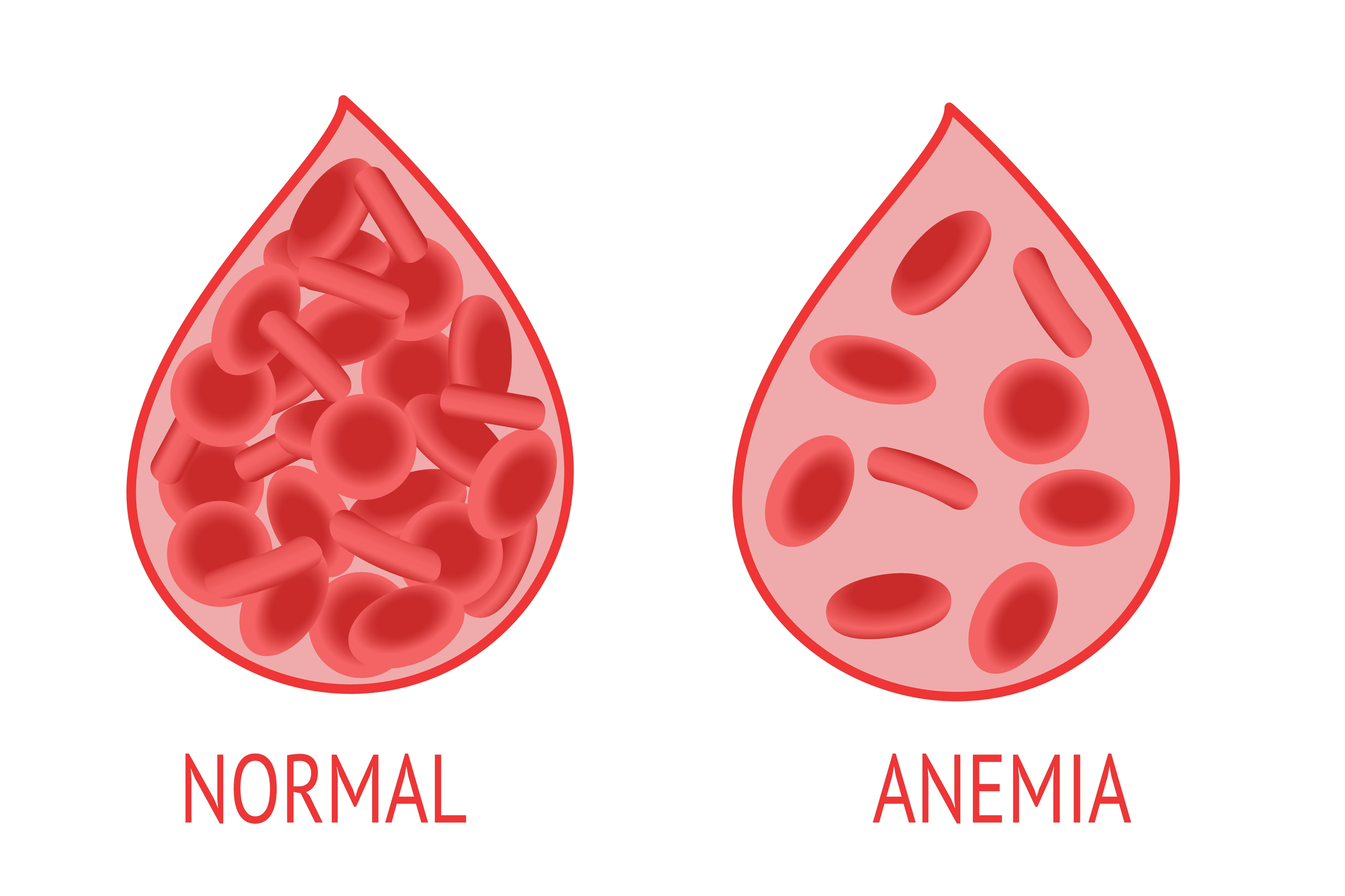 Ilustração de gota de sangue normal e com anemia.