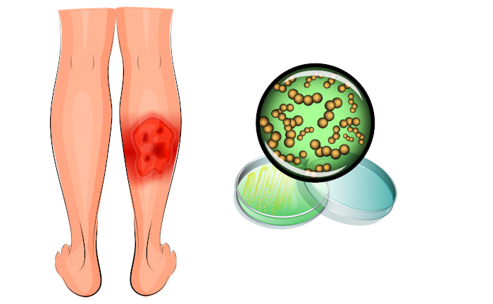 Ilustração representando uma perna acometida por erisipela e as bactérias que causam a doença.