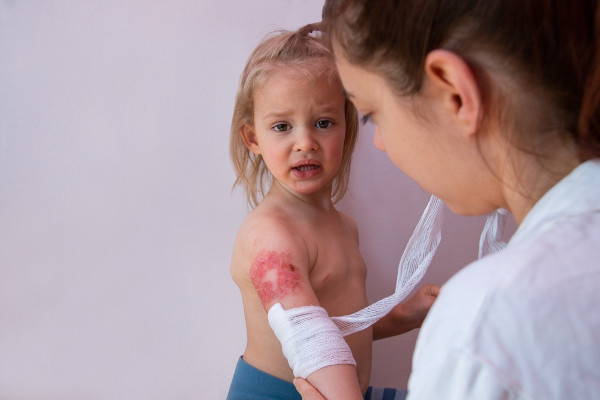 Criança com queimadura no braço recebendo atendimento médico.