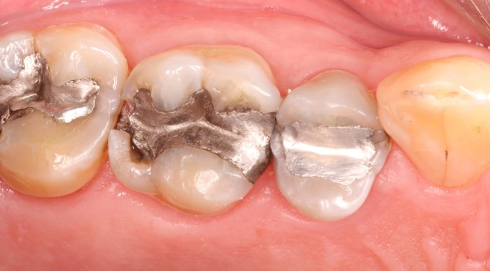 Vista aproximada dos dentes de uma pessoa com amálgamas mercúrio-prata.