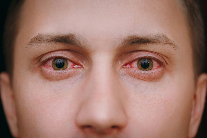Olhos humanos com aspecto vermelho, um sintoma da conjuntivite.