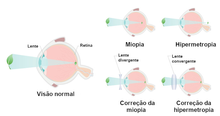 Ilustração da formação da imagem no olho humano na visão normal, na miopia e na hipermetropia.