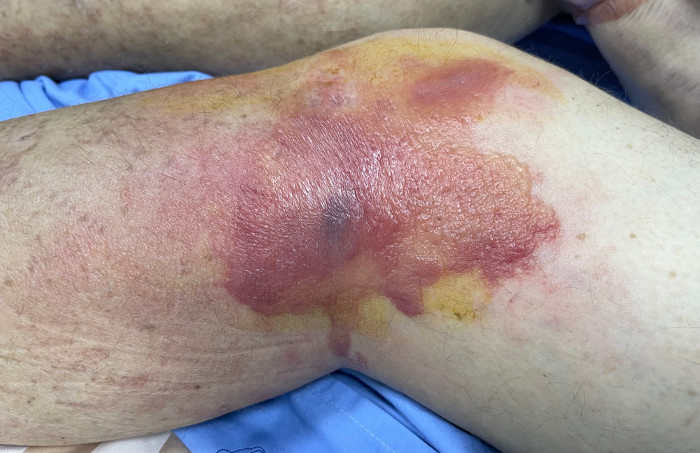 Perna de uma pessoa com lesões vermelhas provocadas pela celulite infecciosa.