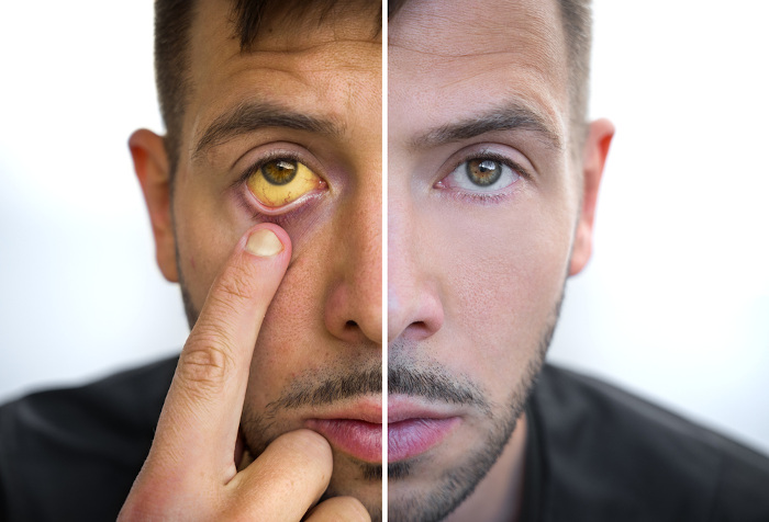 Simulação de um homem com um lado do rosto saudável e o outro com a cor amarelada, típica da icterícia.