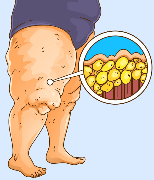 Ilustração mostra nódulos de gordura em perna de pessoa com lipedema.