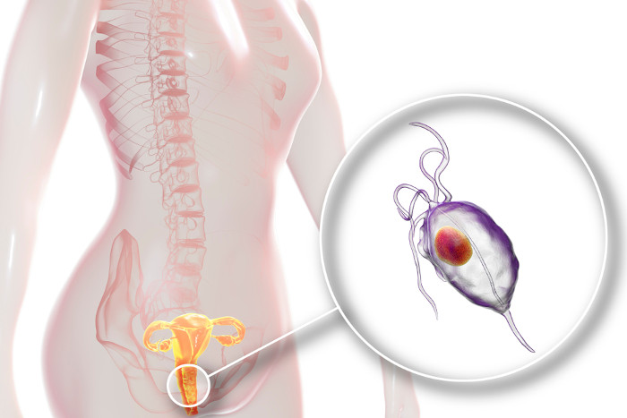 Ilustração 3D do corpo feminino, no detalhe, o protozoário Trichomonas vaginalis no canal vaginal.