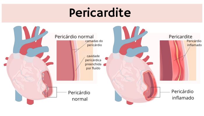Ilustração mostrando um pericárdio normal e um pericárdio acometido por pericardite.