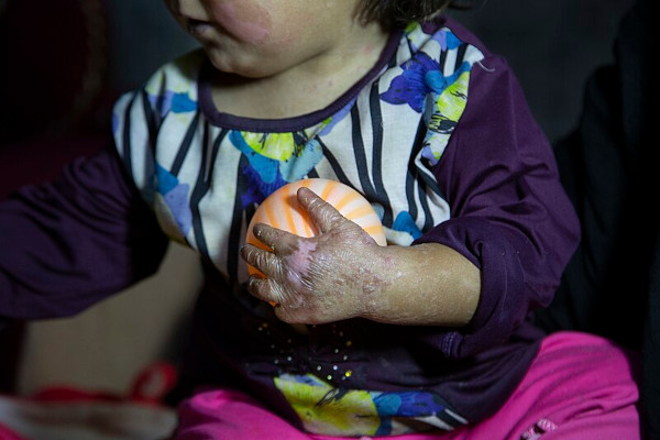 Criança com lesões de epidermólise bolhosa na mão.