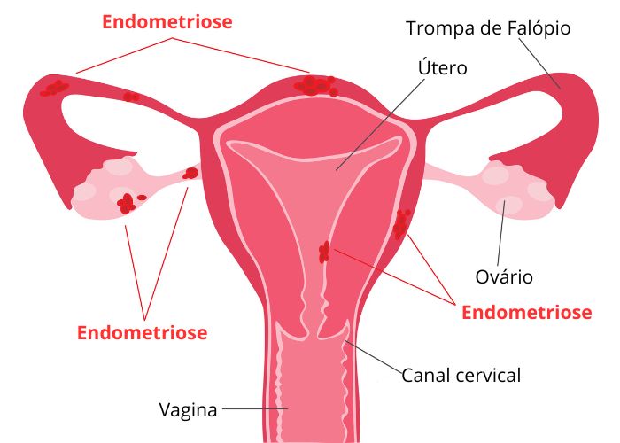 Esquema ilustrativo da endometriose em um útero.