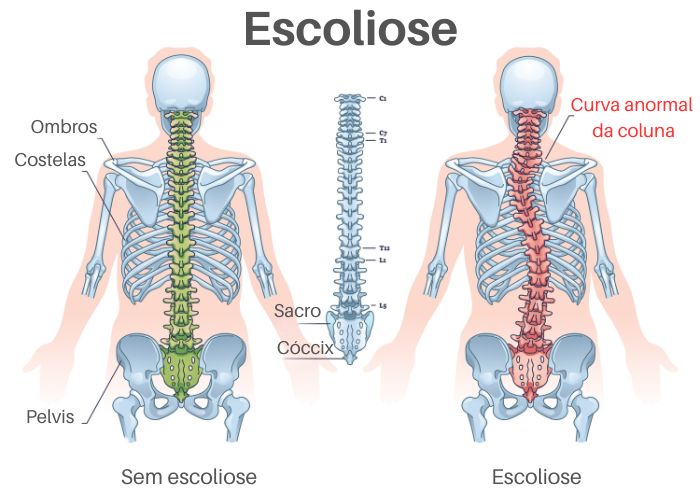 Ilustrando de uma coluna vertebral sem escoliose e de uma coluna vertebral com escoliose.