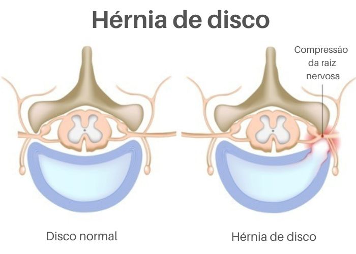 Ilustração mostrando um disco intervertebral normal e um disco intervertebral com hérnia de disco.