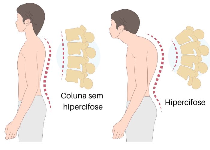 Hipercifose, um dos desvios da coluna vertebral, na região torácica.