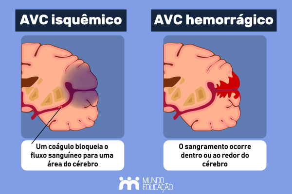 Imagem com os tipos de AVC.